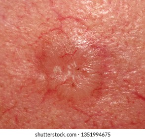 A case of basal cell carcinoma.