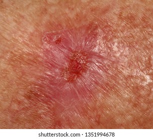 A Case Of Basal Cell Carcinoma.