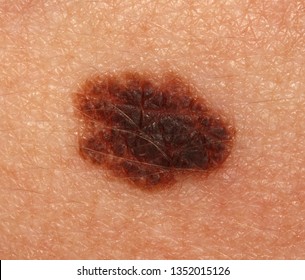 A Case Of A Congenital Melanocytic Nevus.