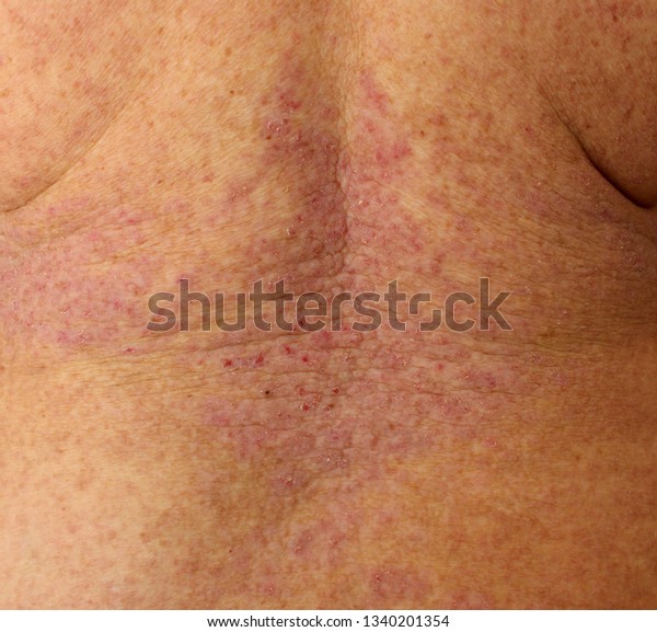 Case Darier Disease Keratosis Follicularis Female Stock Photo (Edit Now ...