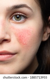 A Case Of Early Rosacea On A Young Woman's Face.