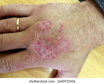 Un caso de eccema (dermatitis)