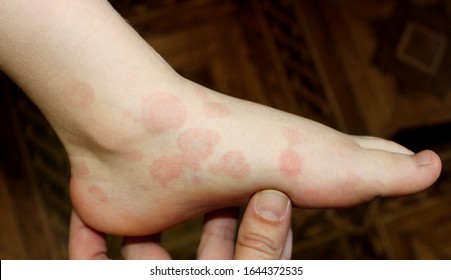 A Case Of Erythema Multiforme In A Child