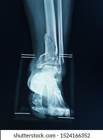 Case a female 45 year old car accident X-ray Left leg multiple fracture distal tibia and fibula,Medical image concept. - Shutterstock ID 1524166352