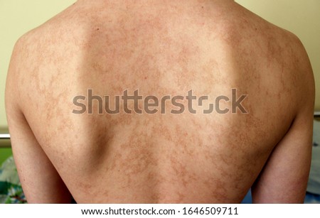 A case of hyperpigmentation of rhe skin due to livedo racemosa in a male