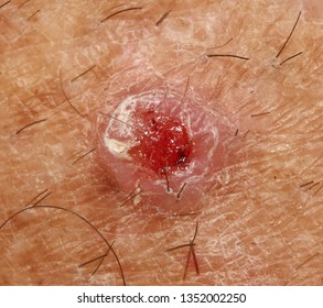 A Case Of An Invasive Squamous Cell Carcinoma.