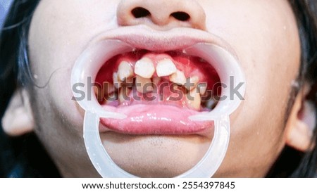 A case of irregularly crowded teeth, which required orthodontic treatment.