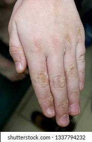 62 Linear skin lesion Images, Stock Photos & Vectors | Shutterstock