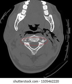 Case Male With Motorcycle Accident And Ct Cervical Spine Show Hangman Fracture