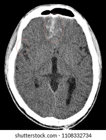 Case Male patient with motorcycle accident and history of loss of conscious  and CT brain was showed traumatic subarachnoid hemorrhage and cerebral contusion at anterior cranial base 