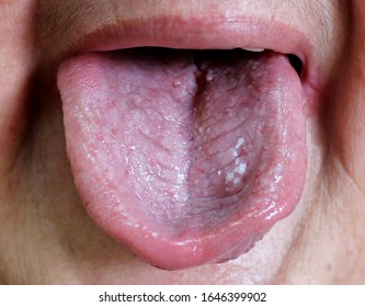 oropharyngeal candidiasis