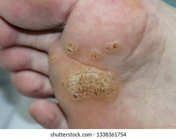 A case of a plantar wart (verruca plantaris) in a young male.