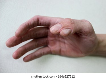 A Case Of Polydactyly In A Male