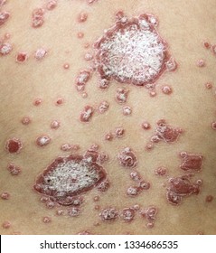 A Case Of Psoriasis In A Child.