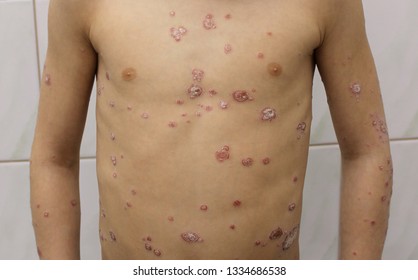 A Case Of Psoriasis In A Child.