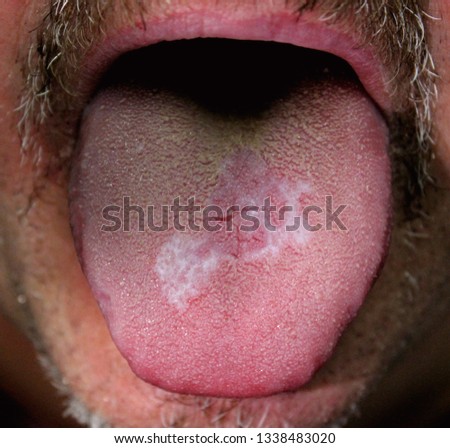 A case of reticular form of oral lichen planus affecting the tongue of a male.