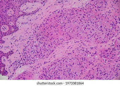 A case of sarcoidosis of the skin showing numerous confluent granulomas in the dermis. Actual microscopic photograph. - Shutterstock ID 1973381864