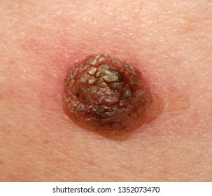 A Case Of Seborrheic Keratosis (senile Wart).