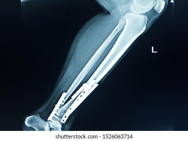 Case traumatic car accident Left leg x-ray post operation fix plate and screws tibia and fibular. - Shutterstock ID 1526063714