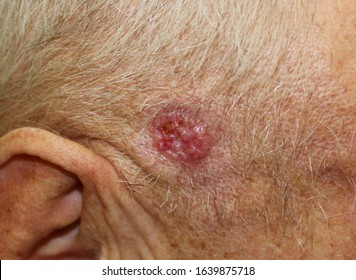 A case of ulcerated nodular basal cell carcinoma