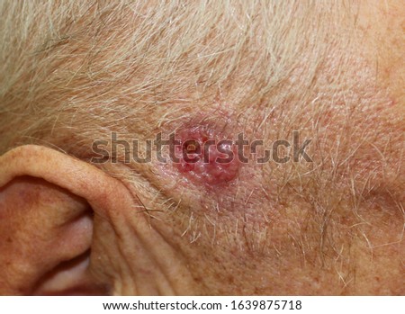 A case of ulcerated nodular basal cell carcinoma