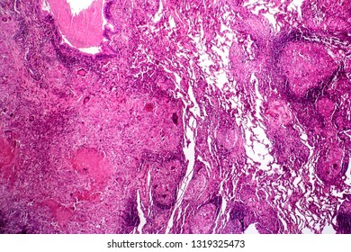 Caseous Pneumonia Light Micrograph Photo Under Stock Photo 1319325473 ...