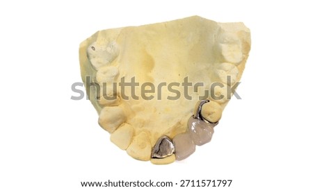 Cast metal framework partial denture on a dental model isolated on white. removable partial denture with a metal frame its a removable dental appliance designed to replace one or more missing teeth. 
