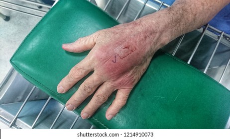 Cat Bite Wound With Cellulitis, Left Hand 