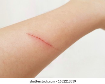 Cat Or Dog Scratch On Arm Isolated On Background.