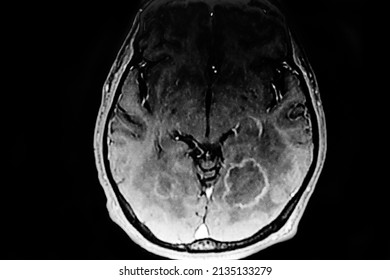 CAT SCAN With Brain Toxoplasmosis. Multiples Brain Tumors With Ring Enhancing Lesion And Perilesional Edema. Located In Mesencephalon And Thalamus White Matter, Cortical And Subcortical Area.