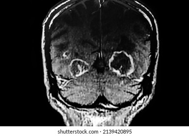 CAT SCAN With Brain Toxoplasmosis. Multiples Brain Tumors With Ring Enhancing Lesion And Perilesional Edema. Located In Mesencephalon And Thalamus White Matter, Cortical And Subcortical Area.