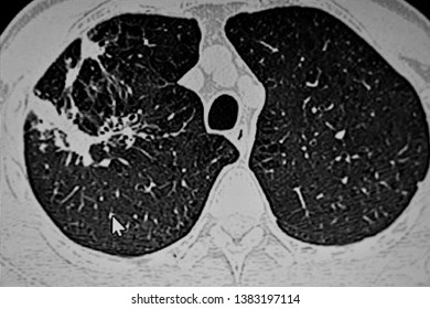 165 Right Upper Lung Images, Stock Photos & Vectors | Shutterstock