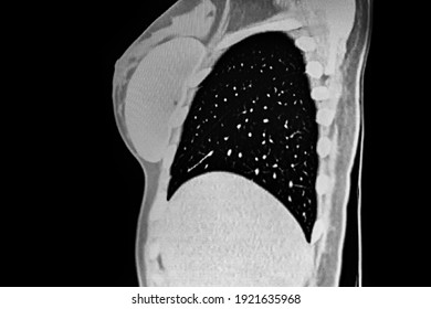 CAT Scan Of Young Female With Breast Prosthesis And Left Upper Lobe Pulmonary Tuberculosis