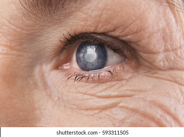 Cataract Concept. Senior Woman's Eye, Closeup