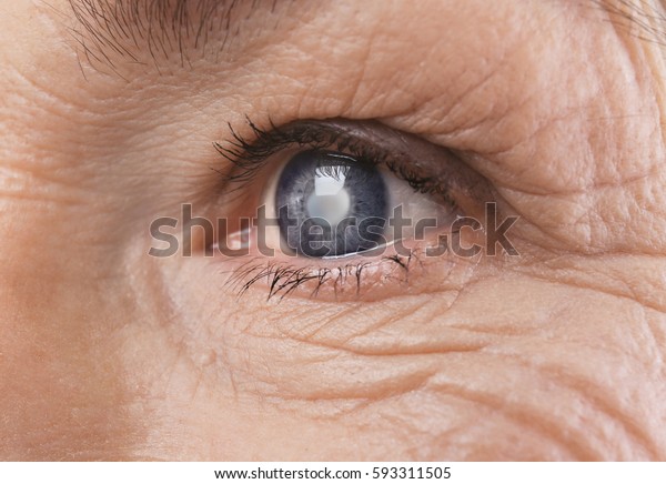 Cataract concept.\
Senior woman\'s eye,\
closeup