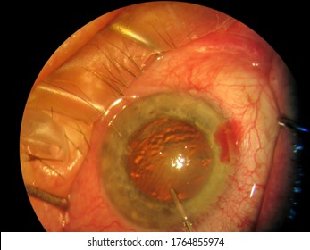 Cataract Surgery With Surgical Microscope View