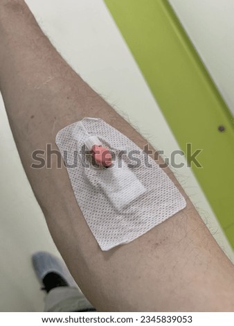 Catheter inserted into the arm before the MRI. Picc (Peripherally Inserted Central Catheter) in the arm. Picc can be used for long-term chemotherapy, antibiotic therapy, or total parenteral nutrition