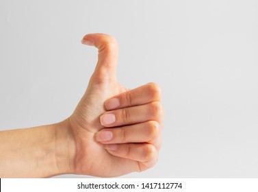 Caucasian Female Hand With Hyper Flexible Thumbs. Curved Thumbs, Hitchhiker's Thumb Syndrome. 