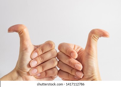 Caucasian Female Hands With Hyper Flexible Thumbs. Curved Thumbs, Hitchhiker's Thumb Syndrome. 