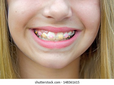 caucasian girl with orthodontic braces on her teeth