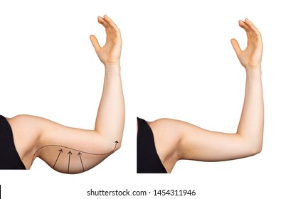 A Caucasian lady holds her arm in the air, isolated against a white background. Arrows show the saggy fat (bingo wing) before surgery. Image on the right shows results after a lift.