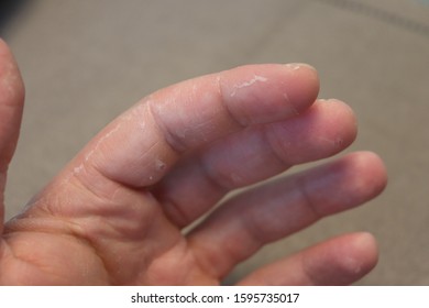 mild psoriasis on hands