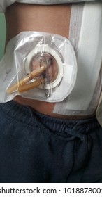 Caucasian Male Patient, 35. Post Surgery Body With Tube, Safety Pins And Drain Outputs