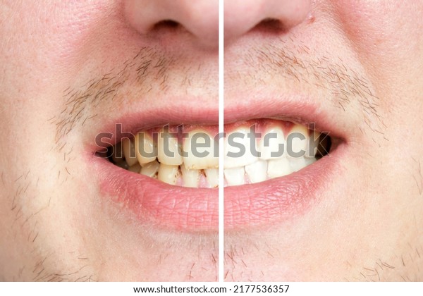 smokers teeth before and after