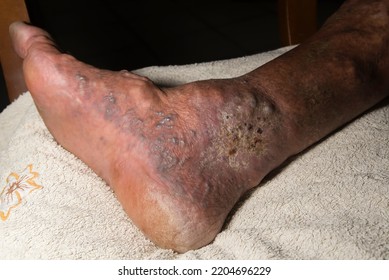 Caucasian man with varicose vein ulcer in healing right lower limb. - Shutterstock ID 2204696229
