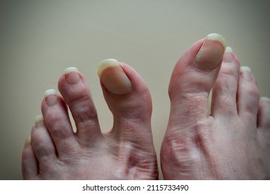 Caucasian Mans Feet Close Up With Long Toenails