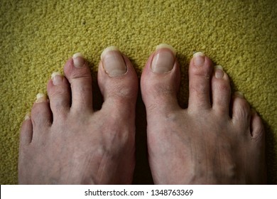 Caucasian Mens Feet With Long Toenails On Yellow Carpet