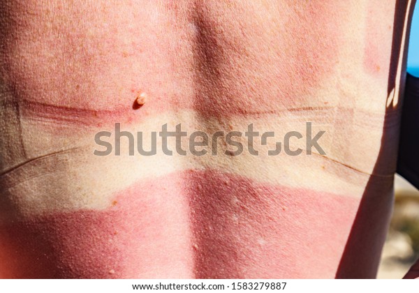 白人女性の背中と肩の皮膚は 日焼けで痛みます 赤いなめし皮膚の重いやけど の写真素材 今すぐ編集