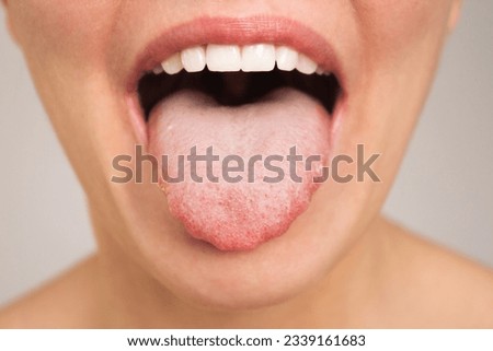 Caucasian woman opens her mouth and shows a sick tongue with teeth marks and a white plaque close-up. Endocrinology. Gastrointestinal diseases