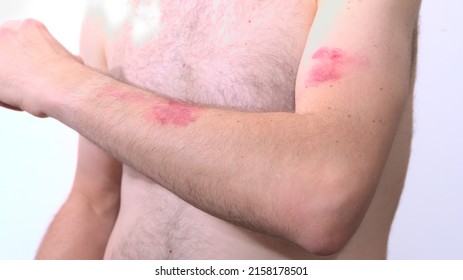Caucasic man feeling elbow with visible skin eruption due to monkey pox